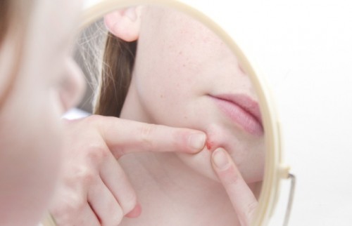 ニキビに悩んだ人の方が肌が老化しにくい　1205組の双子調査で見えてきたこと