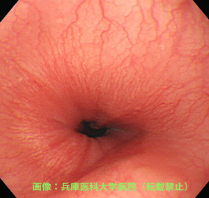 内視鏡で口のほうから食道と胃のつなぎ目を見た画像。つなぎ目が少しだけ開いでいることがわかります。目で見た限り「異常なし」の状態ですが、胸やけなどの症状がある場合は「非びらん性胃食道逆流症(NERD)」との診断がつきます。画像:兵庫医科大学病院(転載禁止)