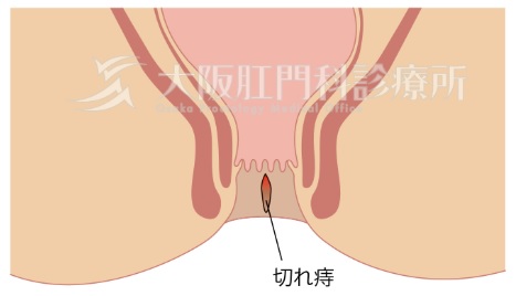 画像提供：大阪肛門科診療所（転載禁止）