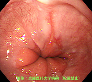 こちらは、食道に炎症(びらん)が生じている「逆流性食道炎(GERD)」の状態。12時の方向に縦に赤いびらん(ただれ)が見えるので、逆流性食道炎と診断されます。この画像の場合、その程度は比較的軽く「軽症」に分類されます。画像:兵庫医科大学病院(転載禁止)