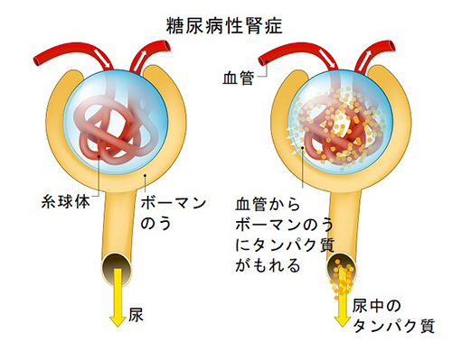 Diabetic,Nephropathy.,Diabetic,Kidney,Disease.,Proteins,In,The,Urine,,Cause