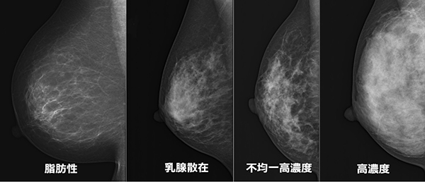 欧米人に比べて日本人は高密度乳腺の人が多く、50歳以下では約80%が高密度乳房＝ドゥイブス・サーチ提供