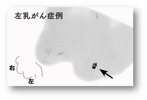 乳腺に邪魔されずにがんが発見できます＝ドゥイブス・サーチ提供